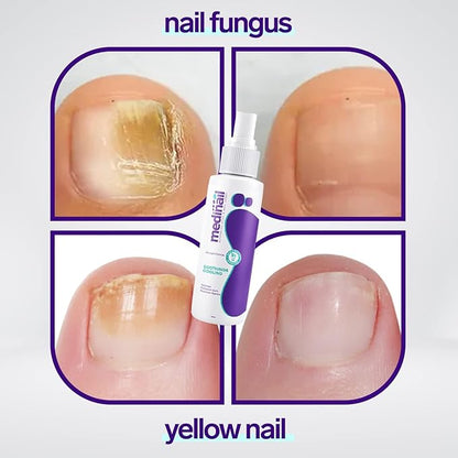 Nail Fungus Spray
